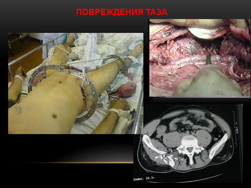 ПОВРЕЖДЕНИЯ ТАЗА